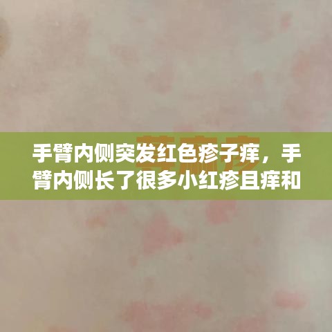 手臂内侧突发红色疹子痒，手臂内侧长了很多小红疹且痒和痛 