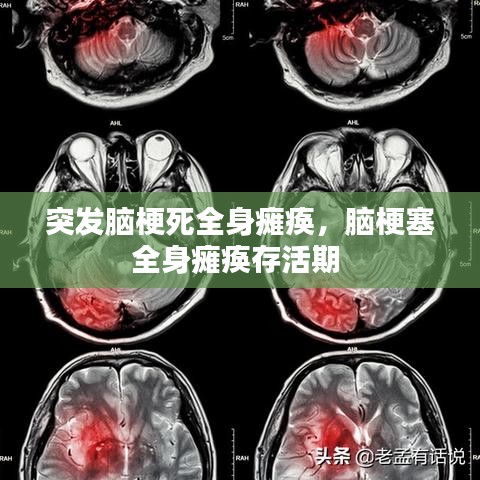 突发脑梗死全身瘫痪，脑梗塞全身瘫痪存活期 
