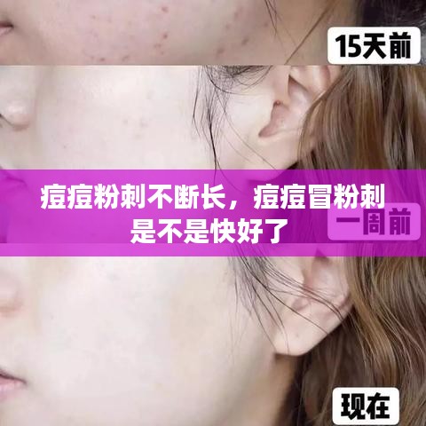 痘痘粉刺不断长,痘痘冒粉刺是不是快好了