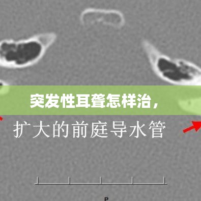 突发性耳聋怎样治,