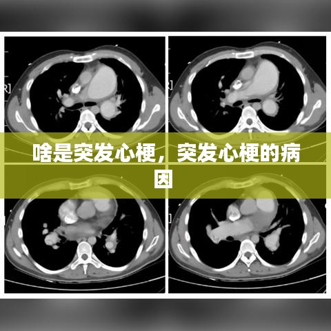 啥是突发心梗,突发心梗的病因