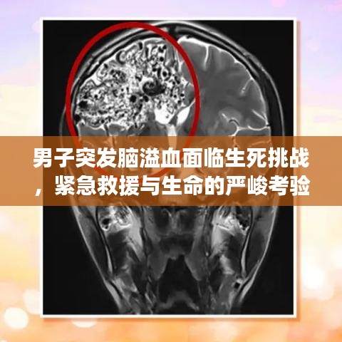 男子突发脑溢血面临生死挑战，紧急救援与生命的严峻考验
