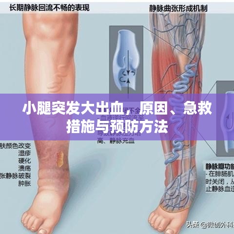 小腿突发大出血，原因、急救措施与预防方法